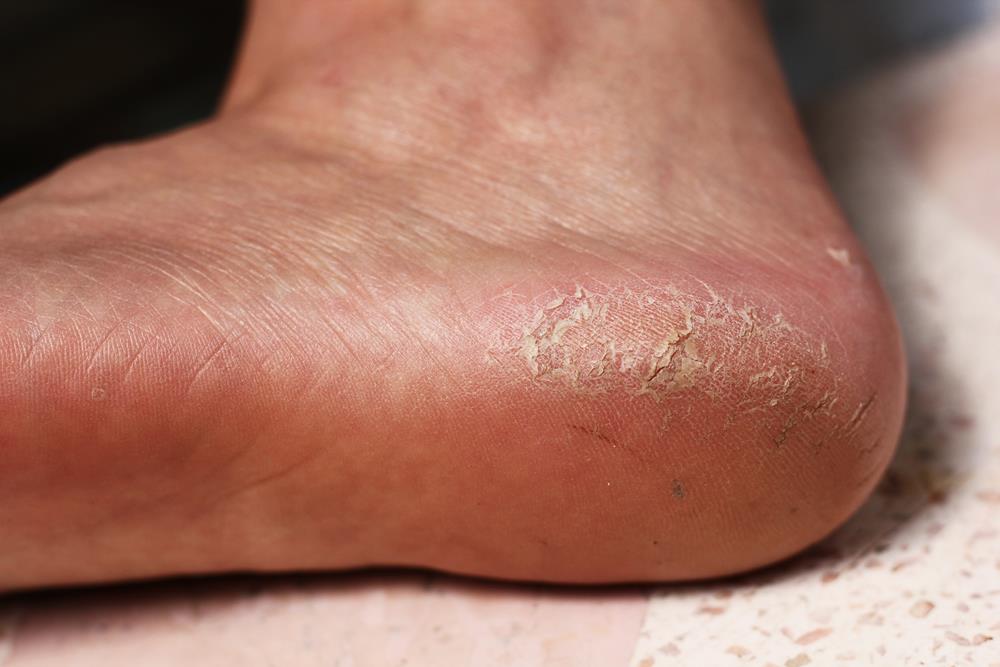 Calluses  Mission Viejo, CA 