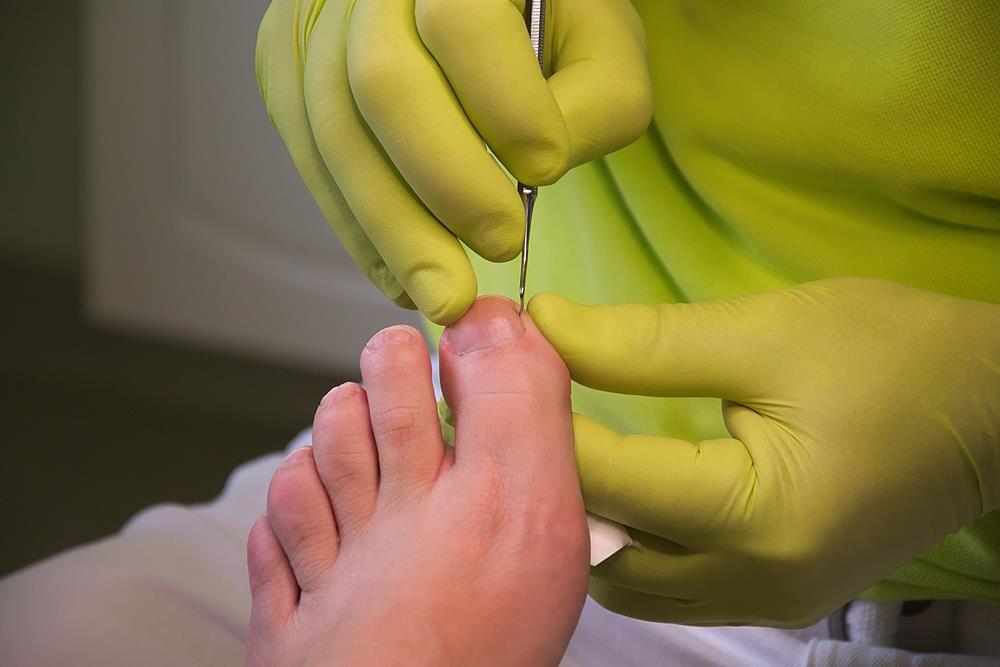 Ingrown Toenails  Mission Viejo, CA 